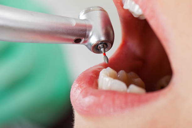 Best Emergency Treatment for Dental Infections or Abscesses in Greenville, DE